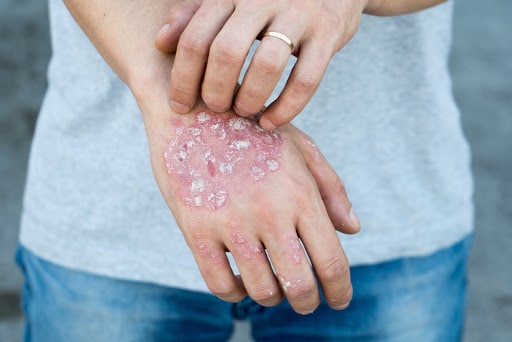 Conheça mais sobre a psoríase: uma doença de pele.